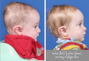 plagiocephaly before and after
