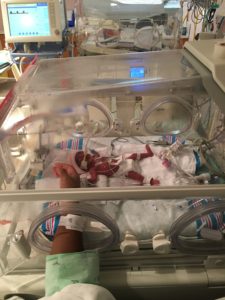 twins, preemie twins, prematurity, IUGR