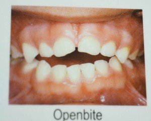 {Professional Insight} Preemie Teeth and Dental Hygiene