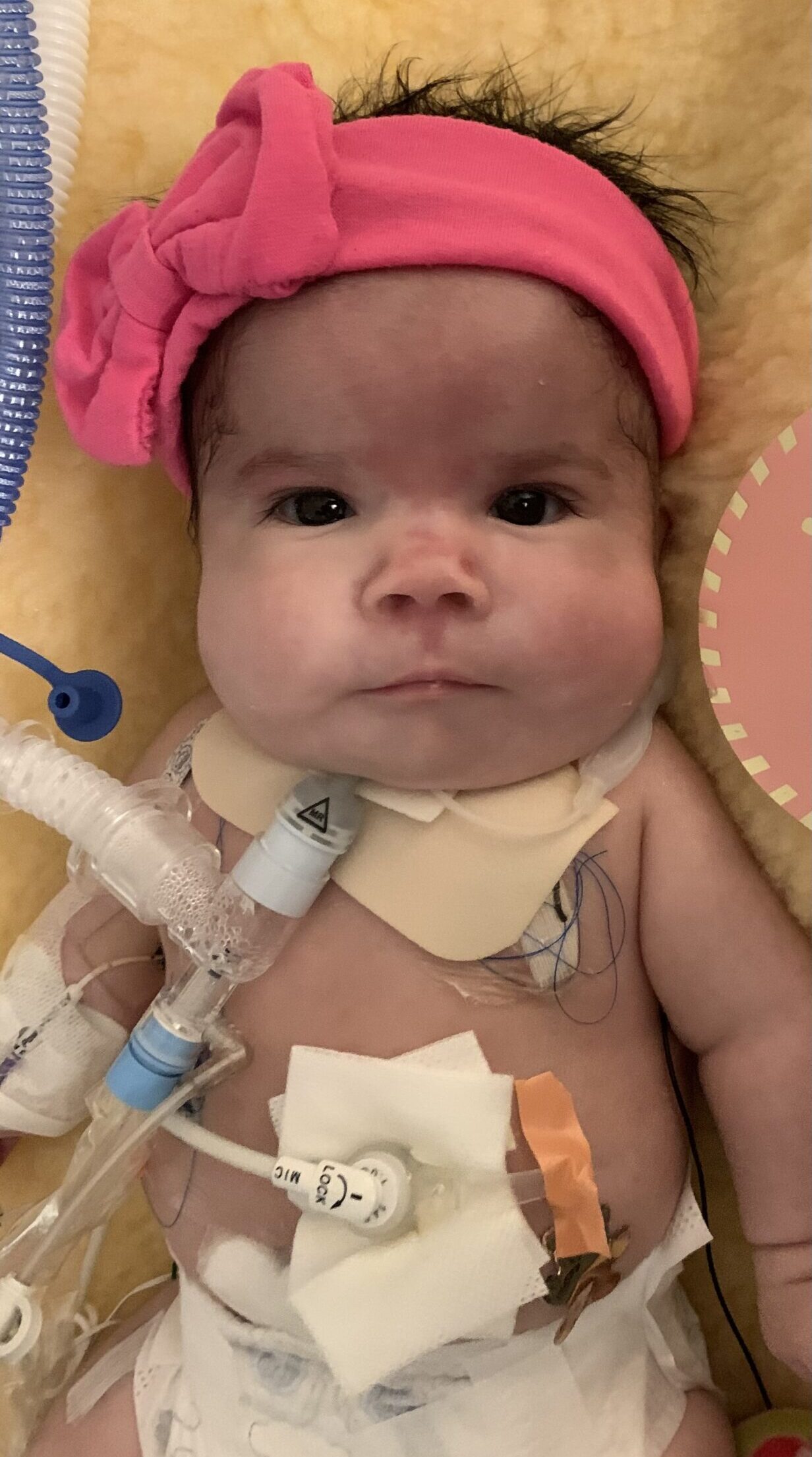 hand to hold, central core disease, g-tube, nicu, fortification