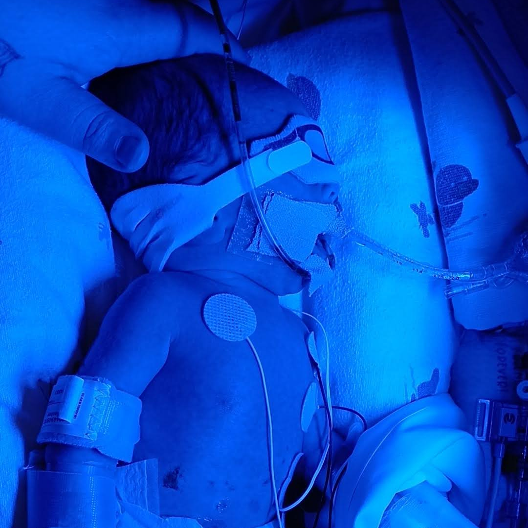 informed consent, hand to hold, NICU baby